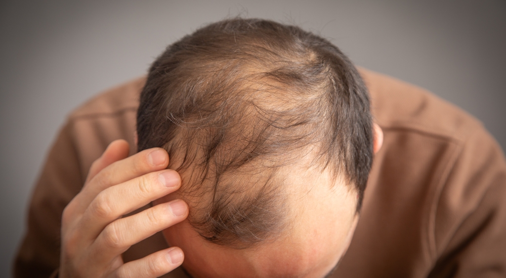 Hair Loss