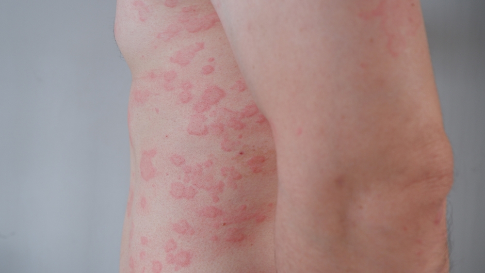 Urticaria