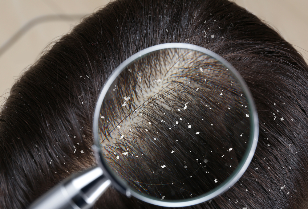 Dandruff