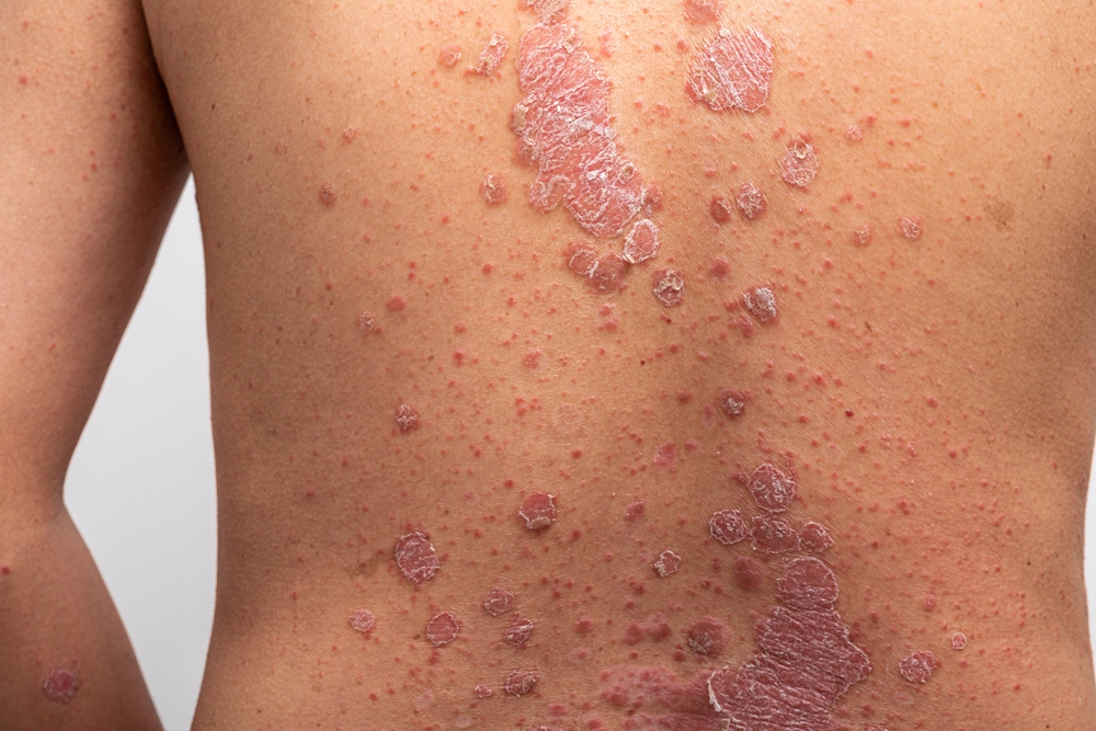Psoriasis